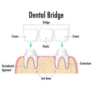 Dental Bridges
