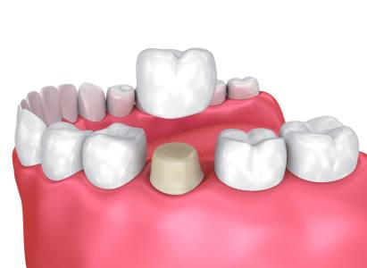 Dental Crowns