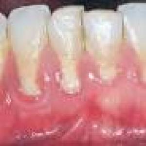 Gums that bleed easily