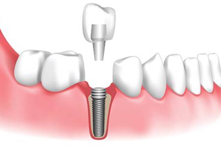 Dental Implants