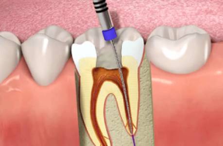 root canal