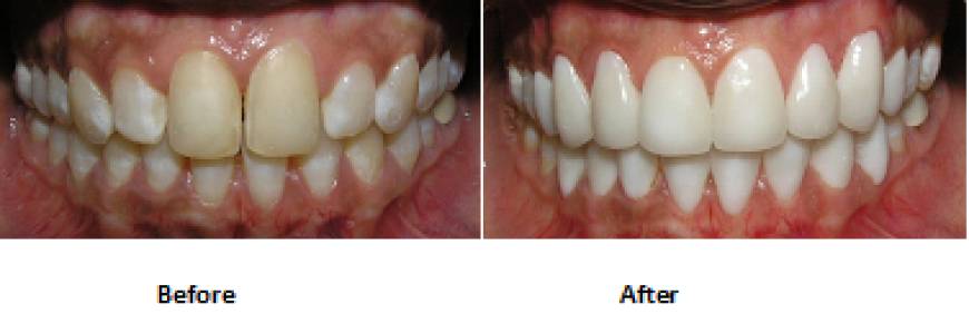 Cosmetic Smile Designing