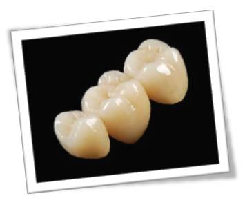 Fixed Teeth Replacement