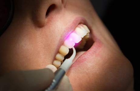 LASER DENTISTRY