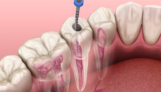 Root Canal Treatments