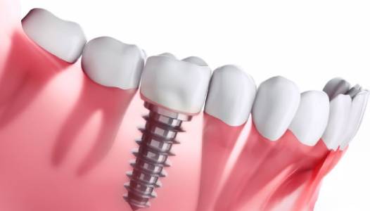 Dental Implants