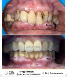 BRACES TREATMENT