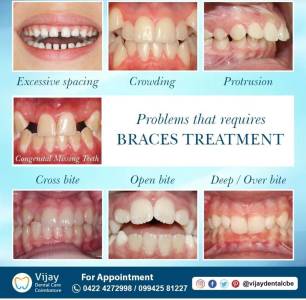 Fixed Teeth(Crown and Bridges)
