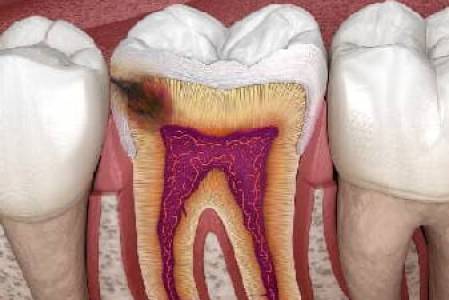 Root Canal Treatment