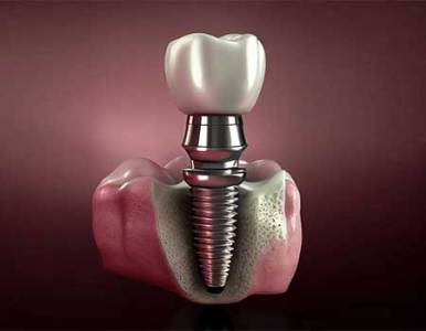 Dental Implants