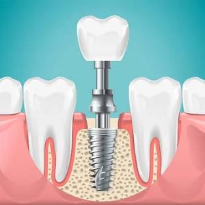 Dental Implant