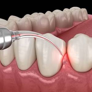 Laser Gum Treatments