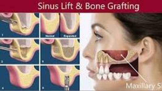 Sinus Lift Surgery