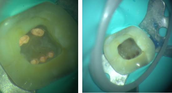 Root Canal Treatment