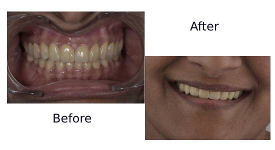 Full Mouth Rehabilitation