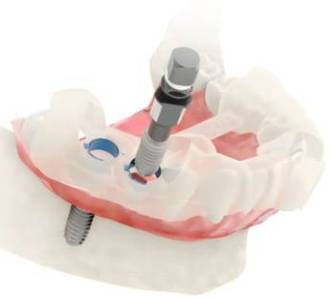 Guided implant surgery