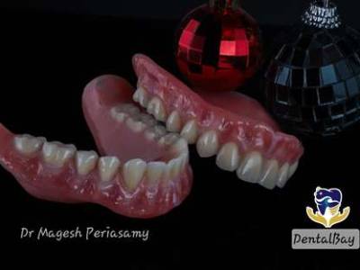 Veneers