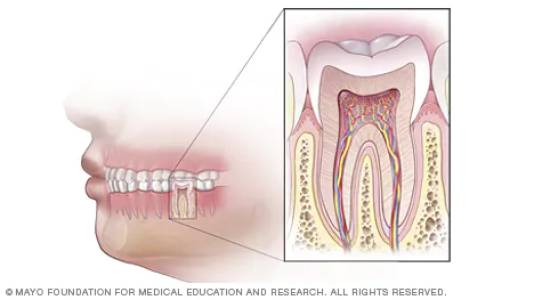 Root Canal Treatment
