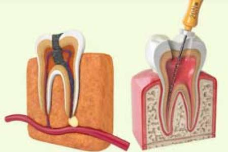 root canal