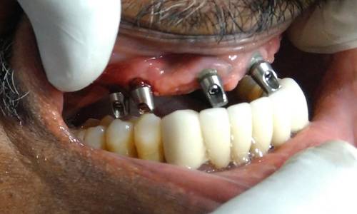 Dental Implants