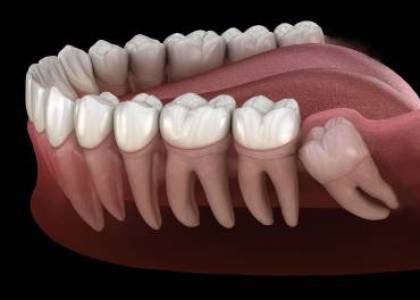 wisdom tooth impacted tooth extraction