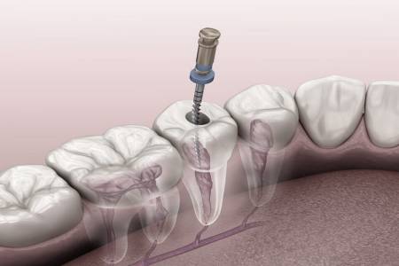 Root Canal Treatment in RS Puram