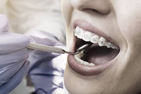 Braces Treatment in RS Puram
