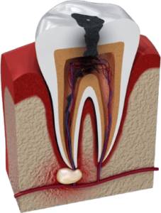 Root Canal Treatment