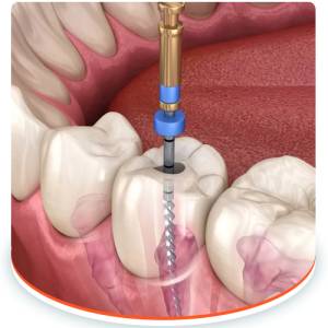 Root Canal Treatment