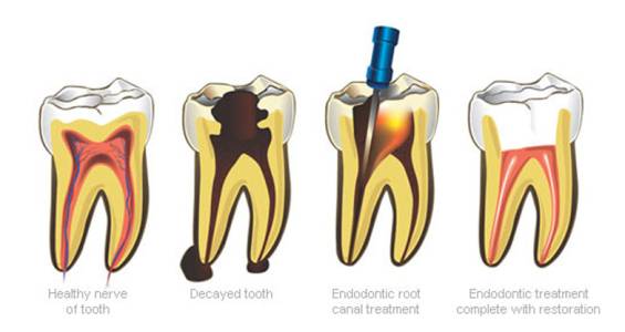 Root canal Treatment- Endodontic treatment