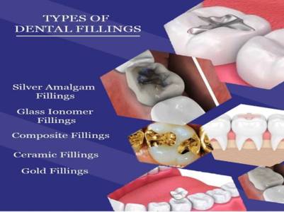 Dental Filling