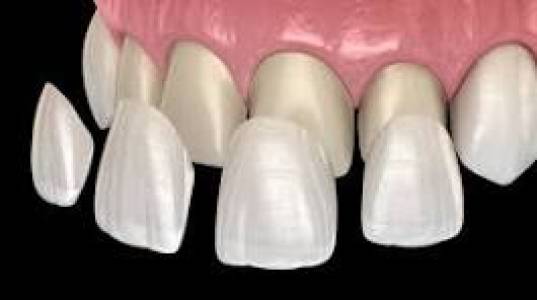 Veneers