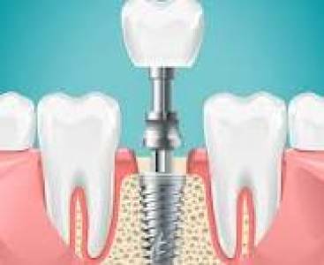 Dental Implants
