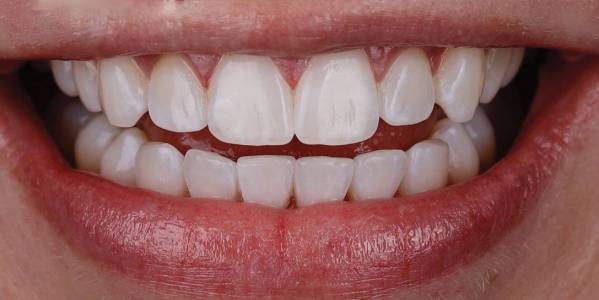 Teeth Alignment
