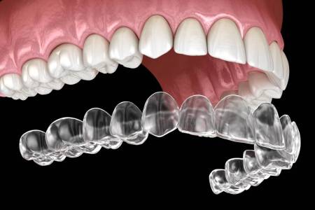 aligners